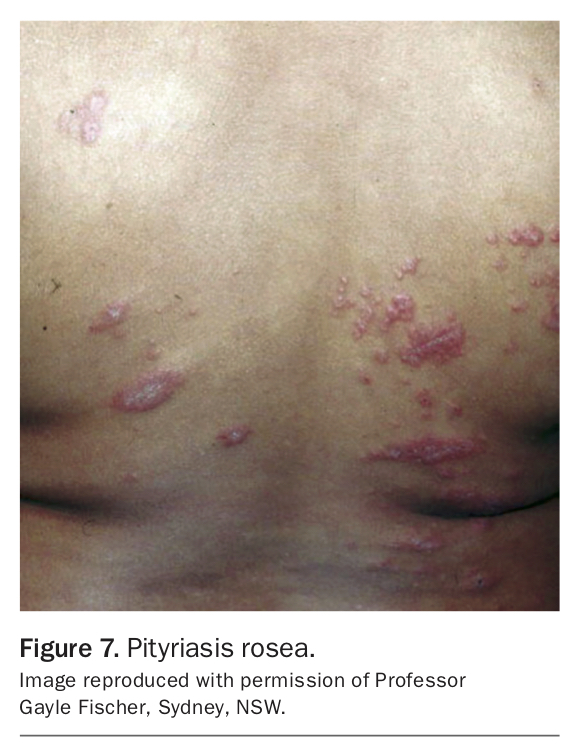 Discoid eczema more than just dermatitis Medicine Today
